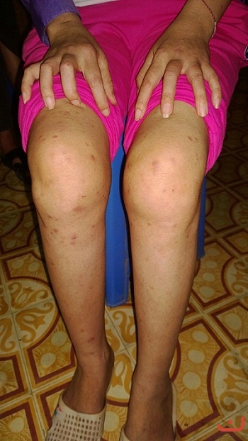 Bệnh nhân Viêm đa khớp