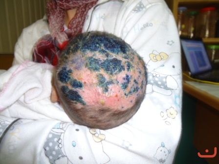 Bệnh nhân bệnh Viêm da đầu đã chữa khỏi