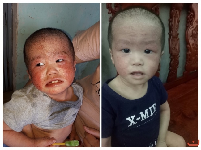 Bé bị viêm da lở loét toàn thân