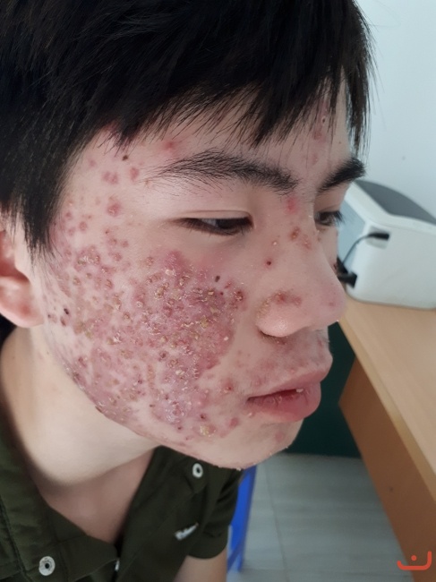 Bệnh nhân viêm da mặt đã được chữa khỏi_5
