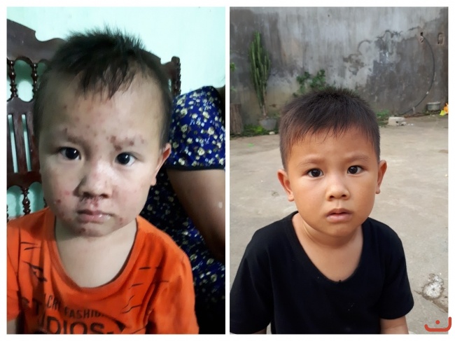 Bệnh viêm da lở loét chữa khỏi_1