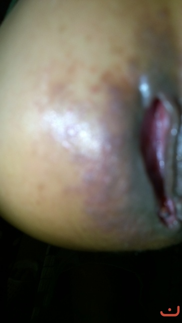 Bệnh nhân 55 tuổi ở Văn Lãng- Lạng Sơn sau khi lấy thuốc về đắp được 2 tuần mủ và nước vàng không còn nữa dần dần khỏi