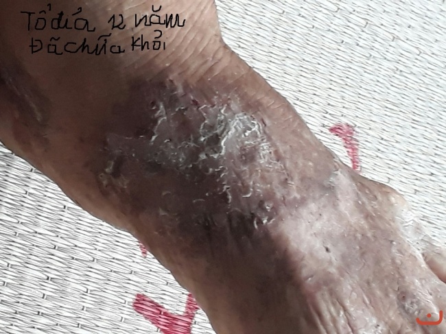 Bệnh tổ đỉa chữa khỏi hoàn toàn bằng thuốc nam