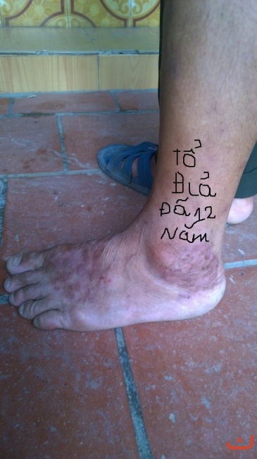 Bệnh tổ đỉa chữa khỏi hoàn toàn bằng thuốc nam (Hình ảnh lúc mới đến lấy thuốc)