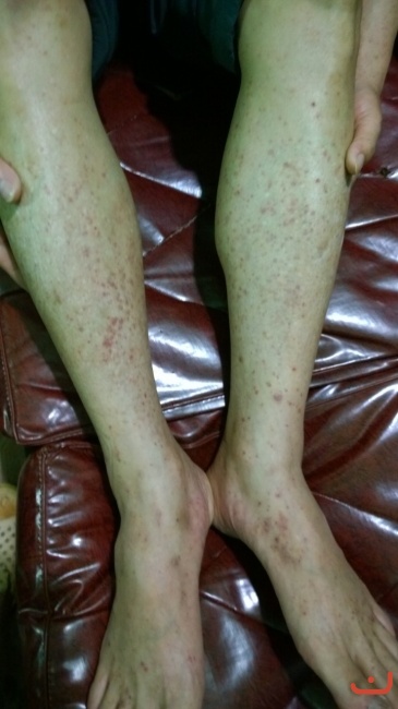 Bệnh nhân Anh là Công an huyện Văn Lãng - tỉnh Lạng Sơn, bị xuất huyết ngoài da chữa thuốc tây y nhiều tháng không khỏi mà còn bệnh càng ngày càng nặng hơn anh đến phòng khám dùng thuốc nam trong một tháng bệnh đã khỏi _1