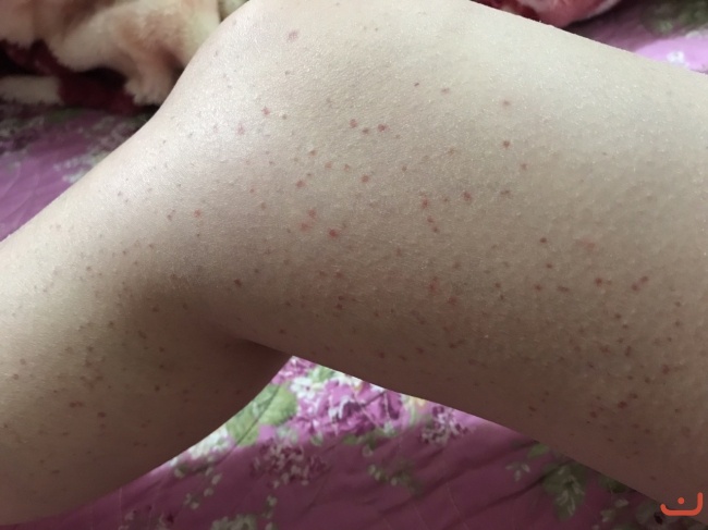 Bệnh nhân Nữ 40 tuổi ở huyện Văn Quan - tỉnh Lạng Sơn, bị xuất huyết ngoài da chữa thuốc tây y nhiều tháng không khỏi mà còn bệnh càng ngày càng nặng hơn chị đến phòng khám dùng thuốc nam trong một tháng bệnh đã khỏi ai bị bệnh như vậy tôi đảm bảo chữa khỏi ( Chữa bệnh bằng thuốc nam an toàn khỏi nhanh chi phí thấp khỏi nhanh)