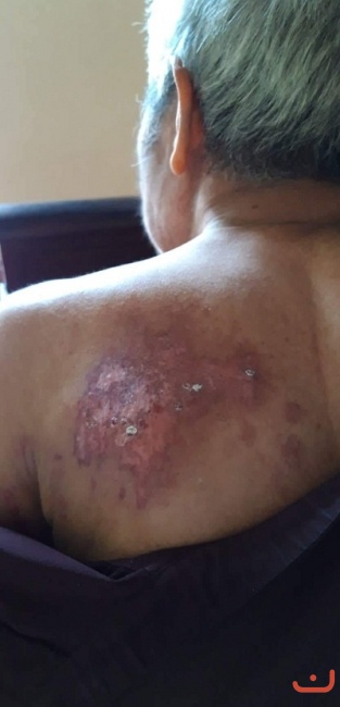 Bệnh zo na thần kinh và di chứng zo na thần kinh_1