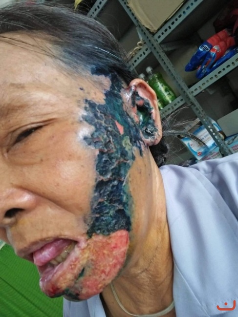 Bệnh zo na thần kinh và di chứng zo na thần kinh_3