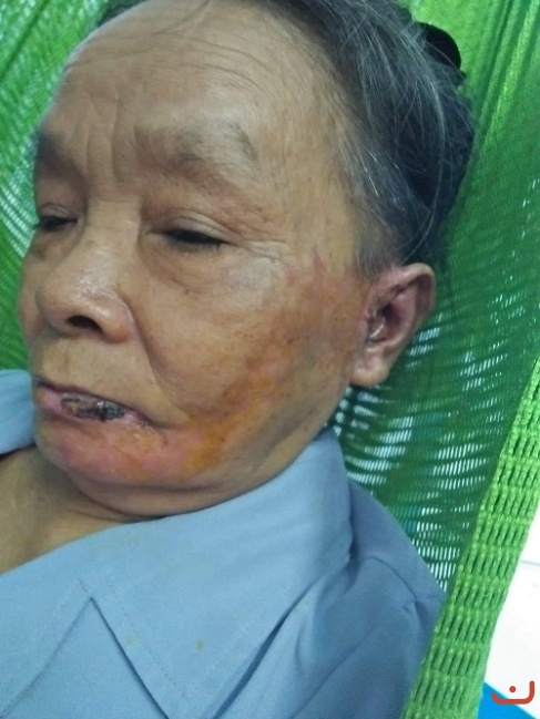 Bệnh zo na thần kinh và di chứng zo na thần kinh_4