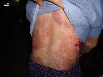 Bệnh nhân bệnh Triệu Thị So 68 tuổi bị bệnh Pemphigus chữa khỏi bằng thuốc nam